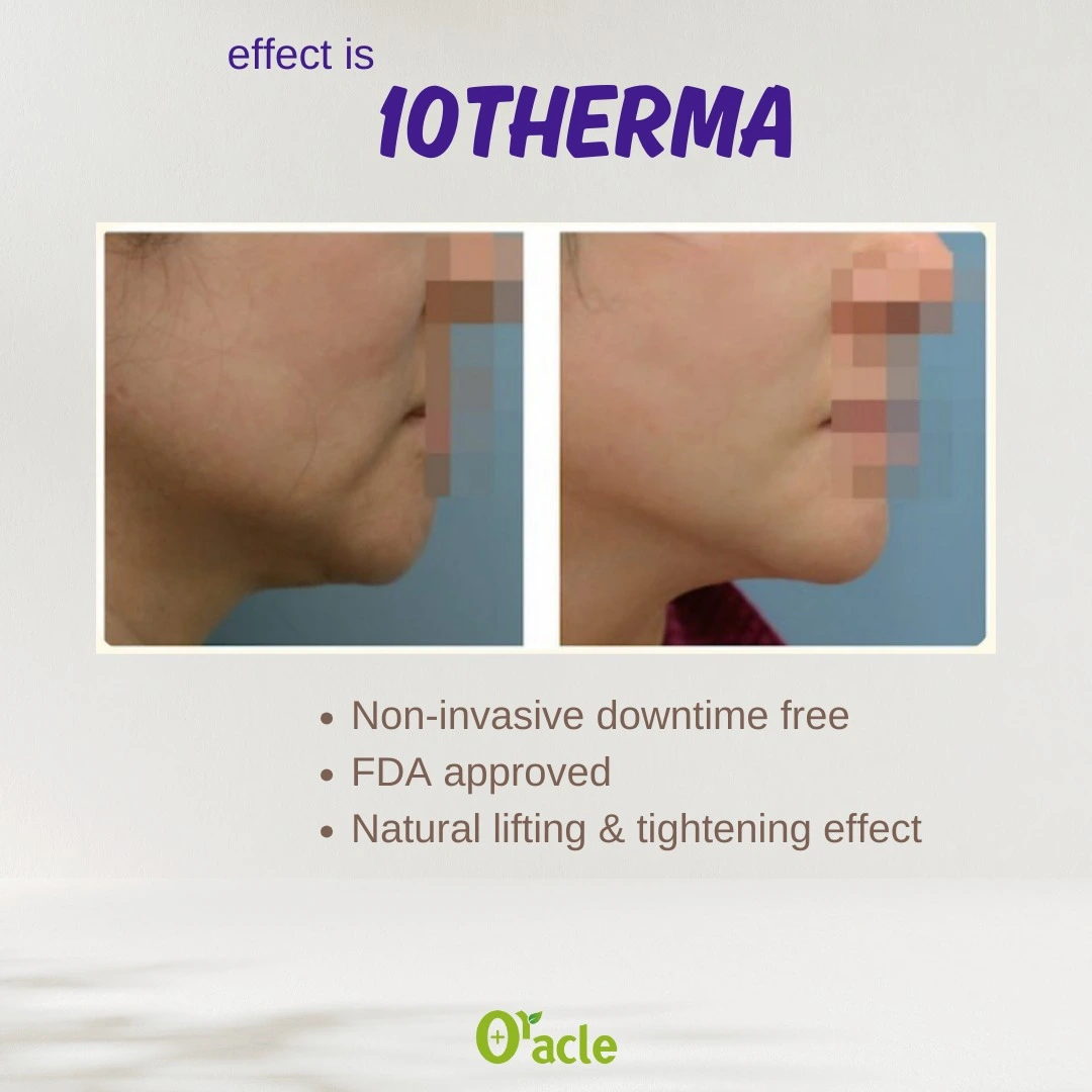 10Thera